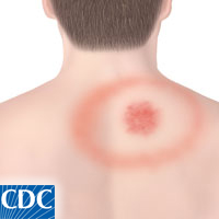 Erythema migrans (EM) or "bull's-eye" rash.