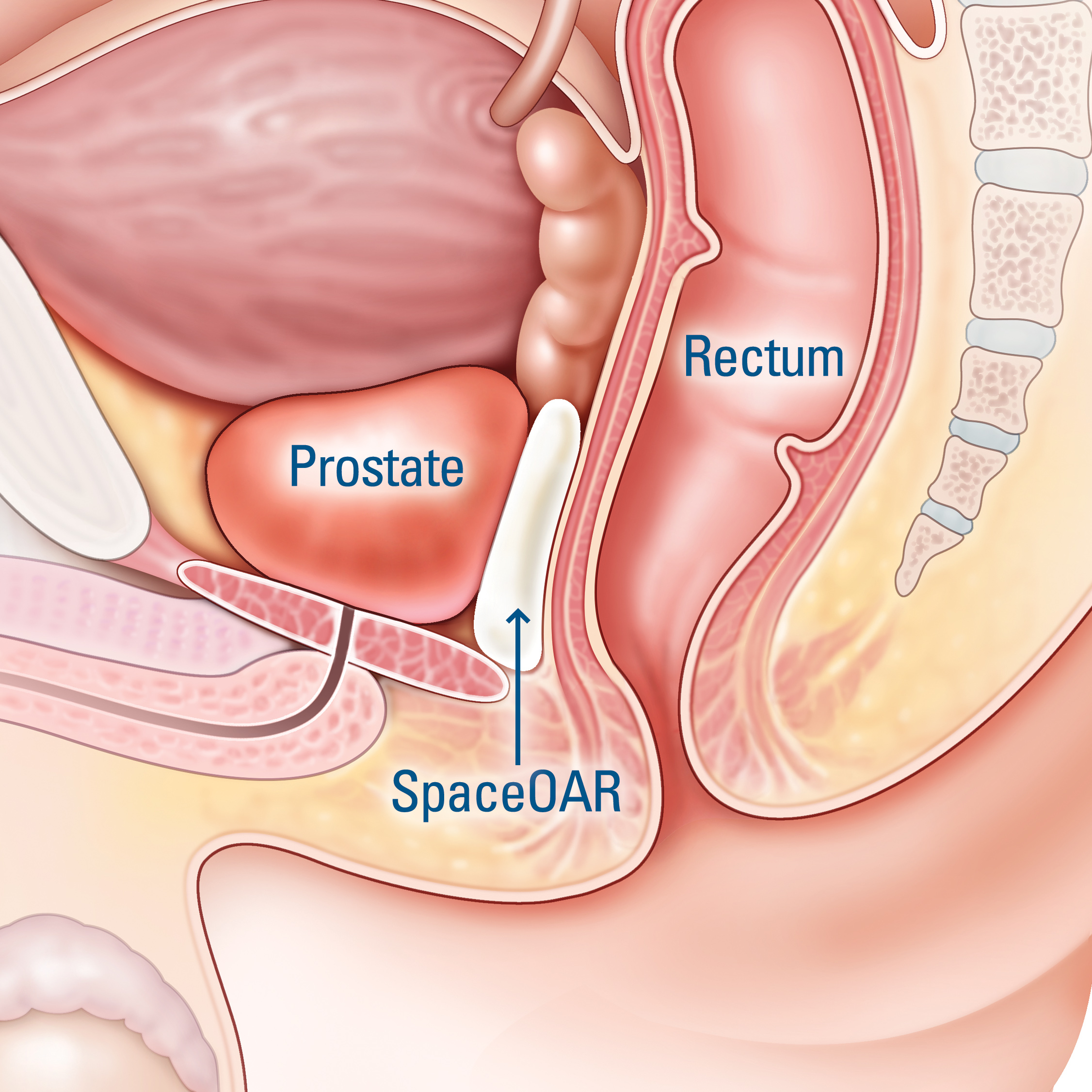 Supravegherea activa: O optiune pentru cancerul de prostata cu risc scazut | p5net.ro
