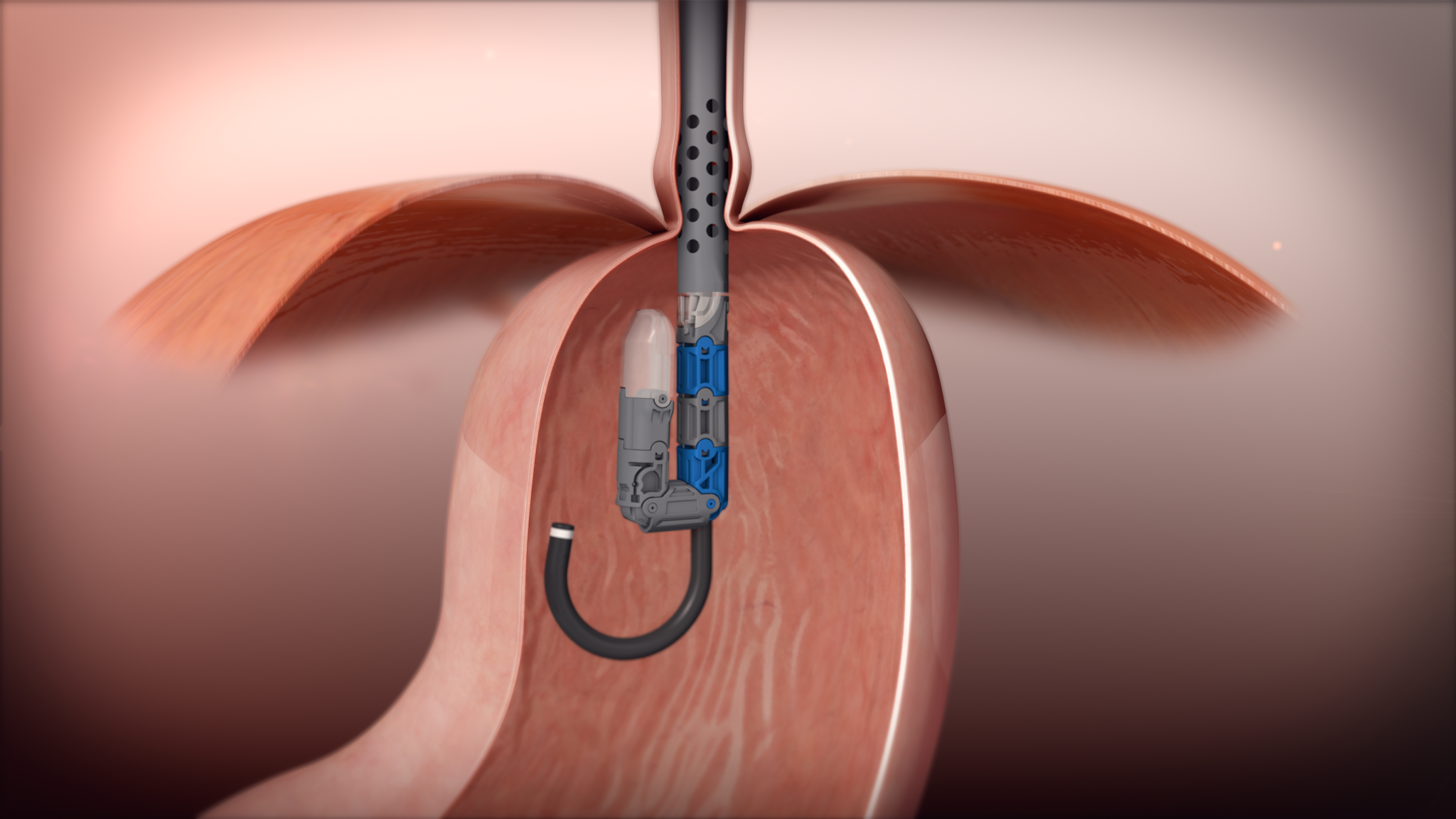TIF Procedure Relief From Acid Reflux Premier Medical Group